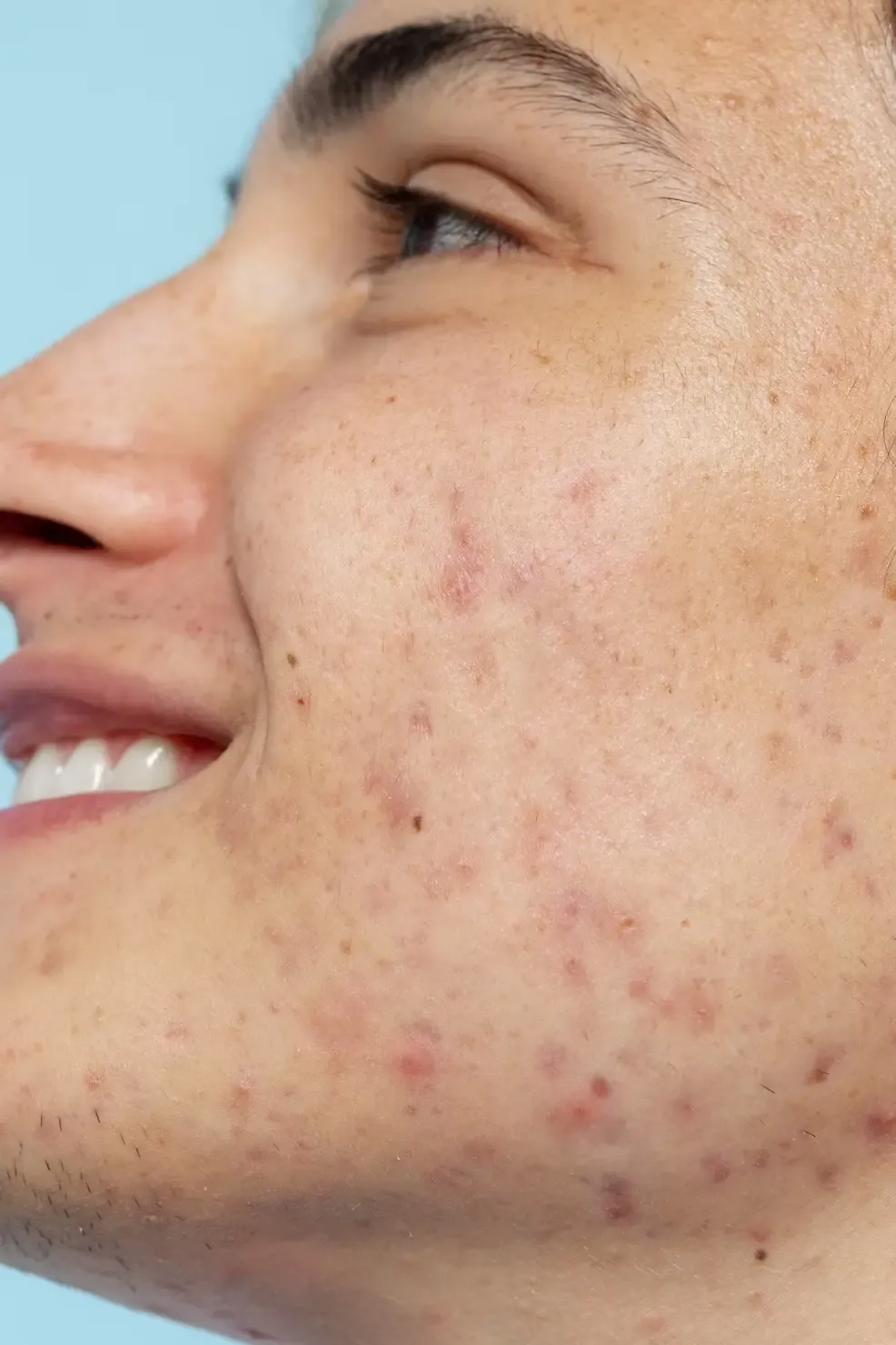 Pele com sinais de flacidez em avaliação para radiofrequência microagulhada Pele com sinais de flacidez em avaliação para radiofrequência microagulhada