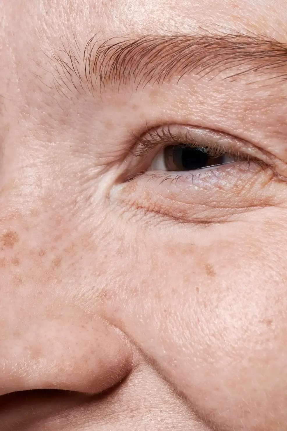 Pele com manchas de melasma próximas à região dos olhos Pele com manchas de melasma próximas à região dos olhos