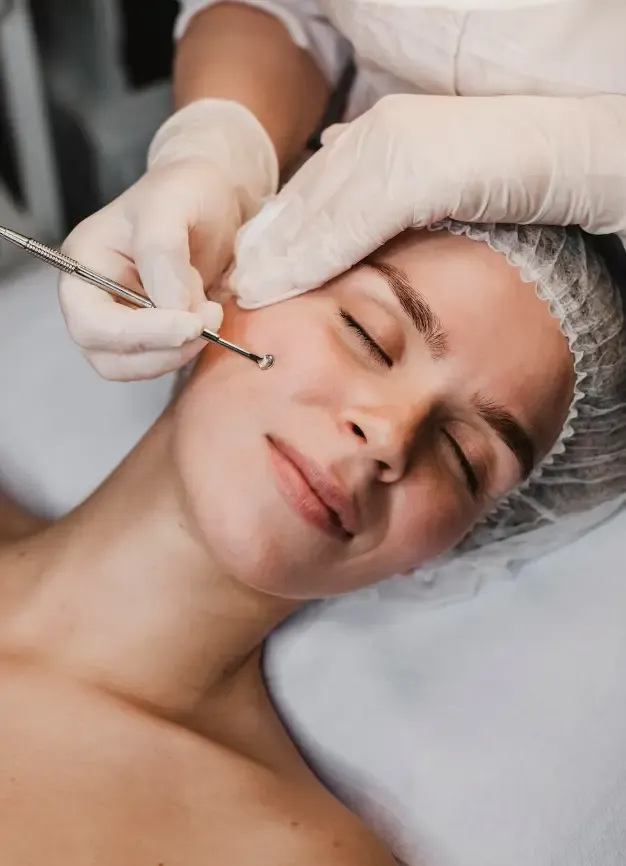 Procedimento dermatológico para tratamento de acne em consultório Procedimento dermatológico para tratamento de acne em consultório