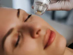 Radiofrequência Microagulhada Radiofrequência Microagulhada