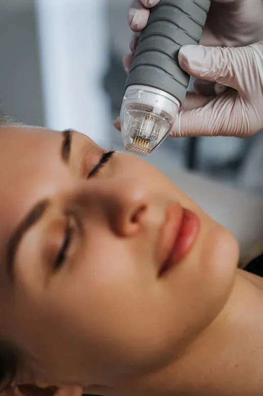 Radiofrequência microagulhada em consultório dermatológico em Ribeirão Preto Radiofrequência microagulhada em consultório dermatológico em Ribeirão Preto