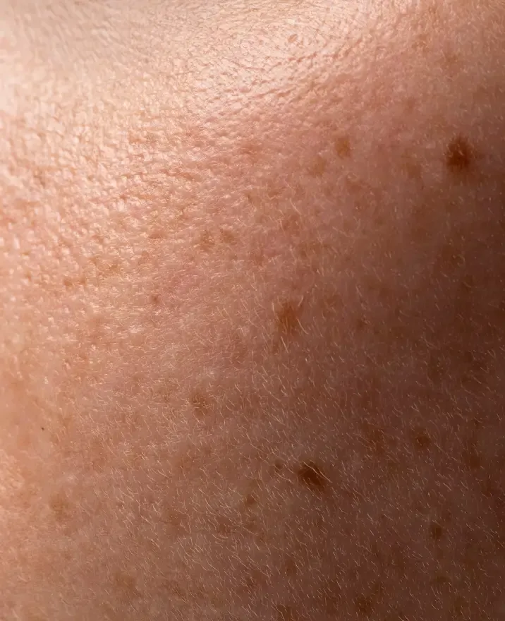 Exame da pele para avaliação dos sinais de melasma Exame da pele para avaliação dos sinais de melasma