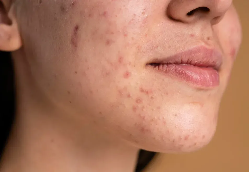 Tratamento de acne em consultório dermatológico em Ribeirão Preto Tratamento de acne em consultório dermatológico em Ribeirão Preto