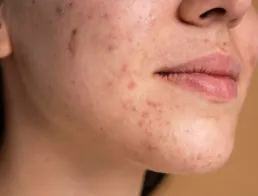 Tratamento de Acne